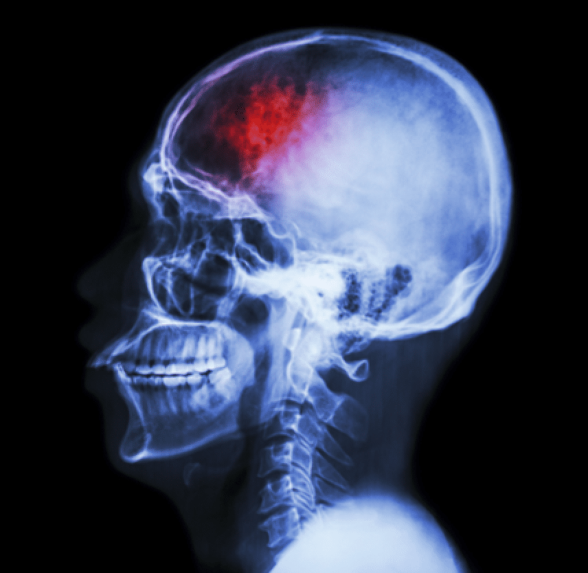 Dramatization of an x-ray indicating a head injury TBI - Oliver Law Office