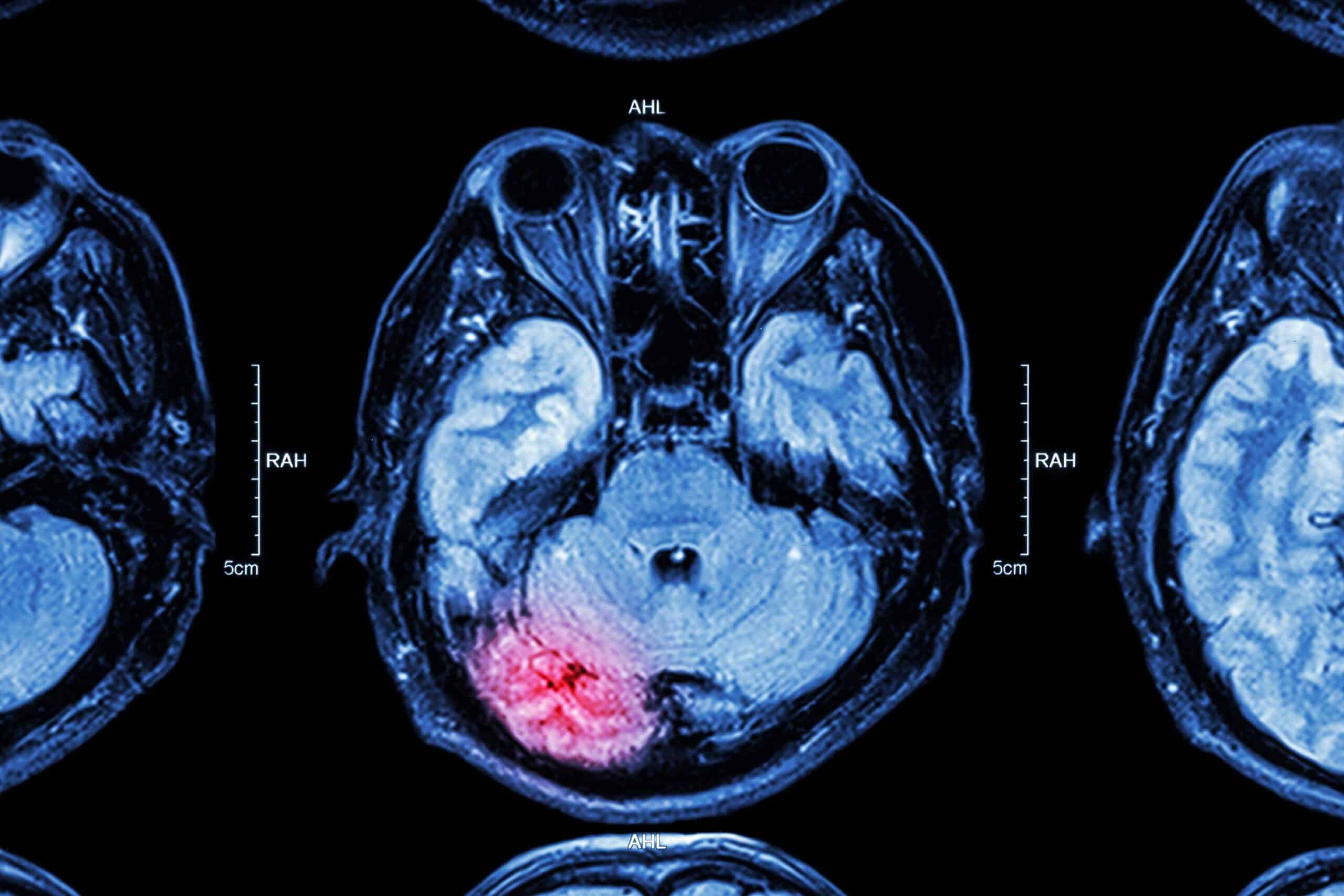 TBI MRI Traumatic-Brain-Injury-mri - Oliver Law Office