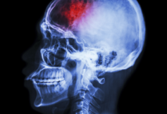 Dramatization of an x-ray indicating a head injury
