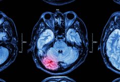 TBI MRI